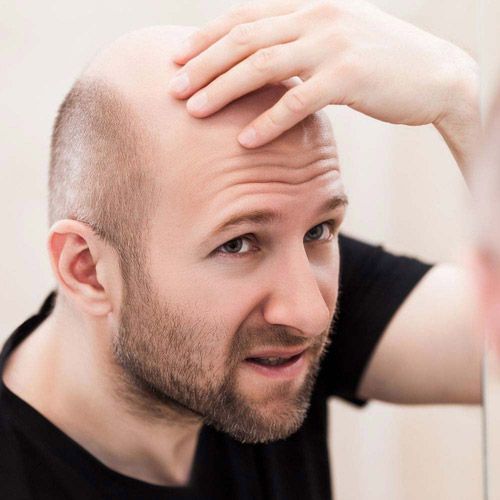 What Is Male Patern Baldness Causes Cure More Man Matters