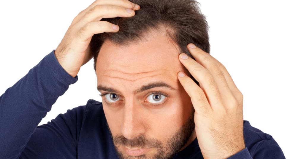 Can dandruff cause hair loss? | Man Matters
