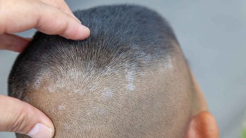 Dandruff Causes Gray Hair? Is it a Myth Or a Fact? | Gaizupath