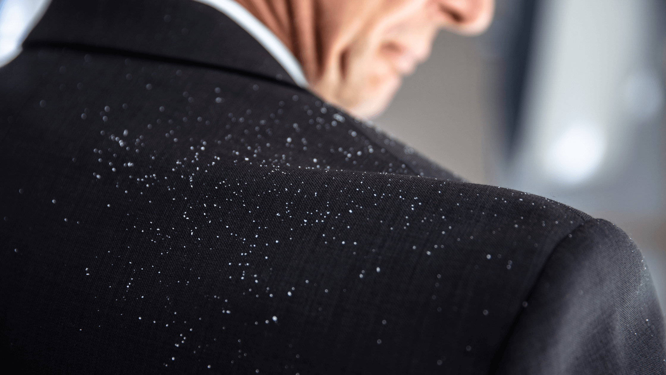 how-to-remove-dandruff-for-men-man-matters