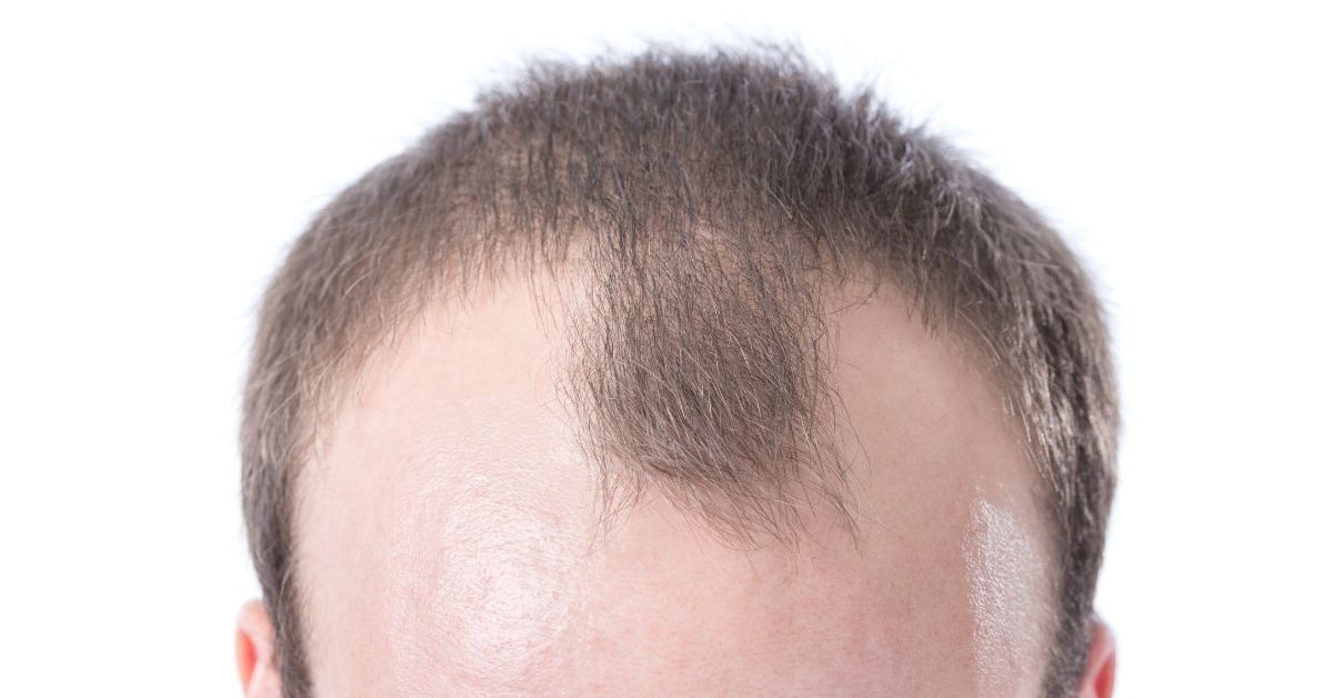 The ULTIMATE Redensyl Hair Growth Pack (Men) – Ctom Ltd