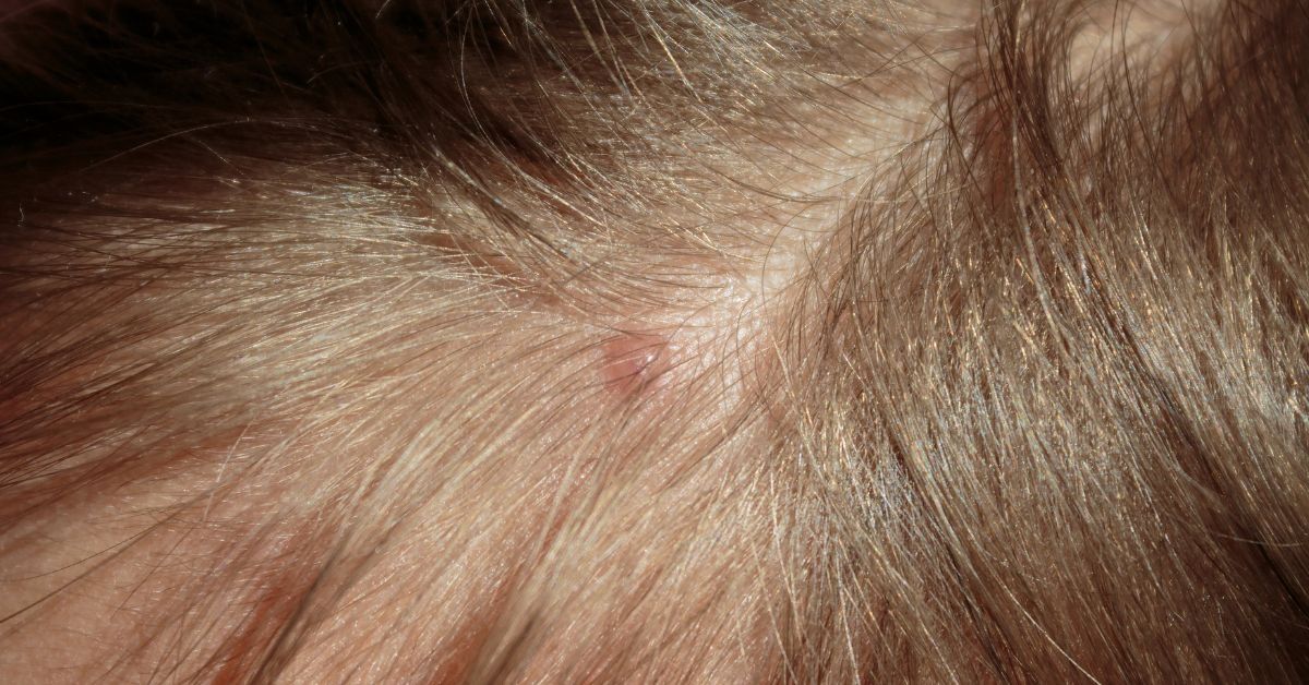 Here's How to Treat Pimples on Scalp: Home Remedies Causes, and Prevention