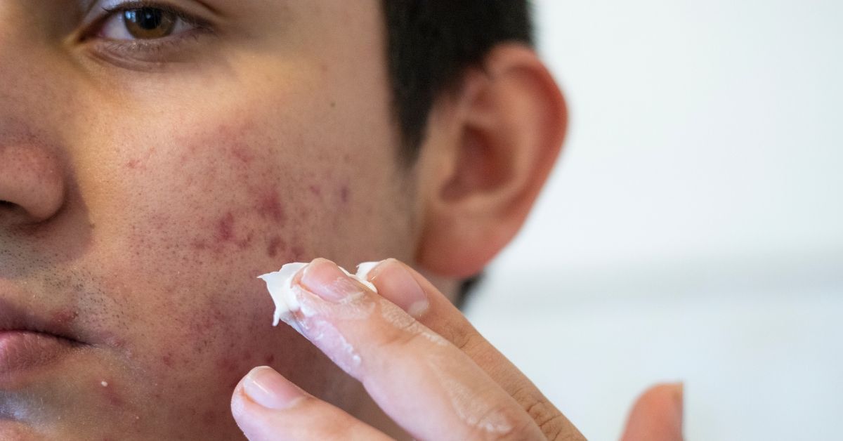 how to get rid of boxcar acne scars