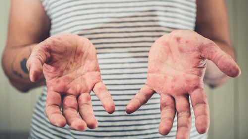 What is Asteatotic Eczema?
