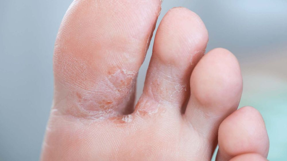 What Is Athlete's Foot?