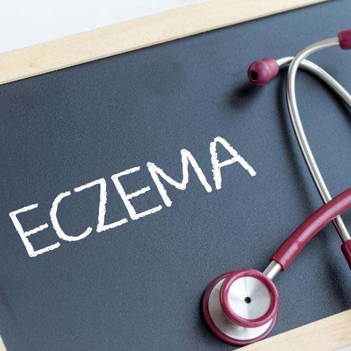 Eczema Treatment: Home Remedies, Ayurveda & Homeopathy