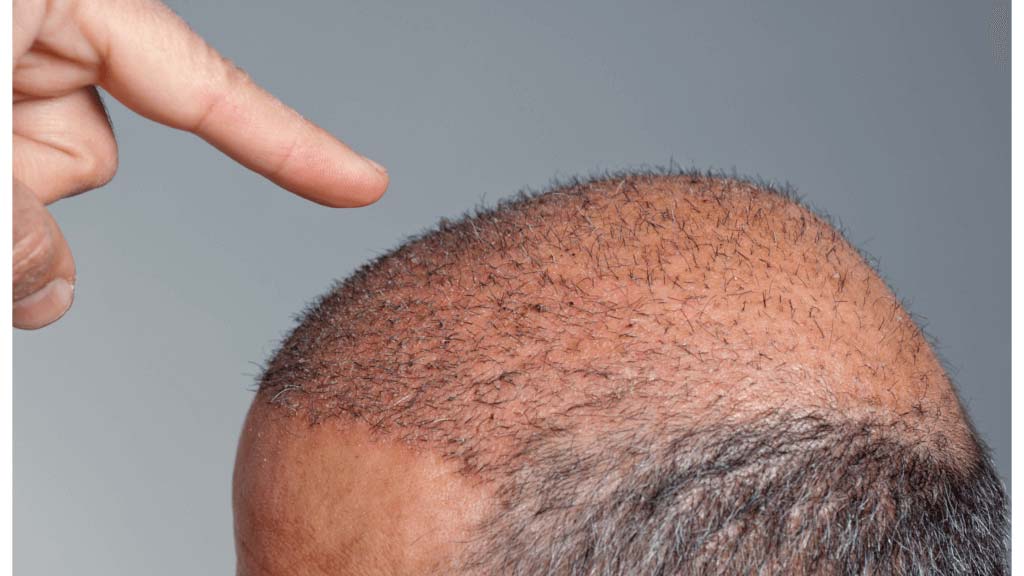 Hair Transplant for Men | Hair Loss Solution