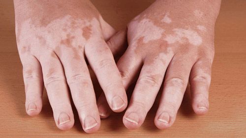 Homeopathic Treatment for Vitiligo