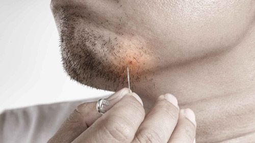 What is Ingrown Hair? Everything You Need To Know