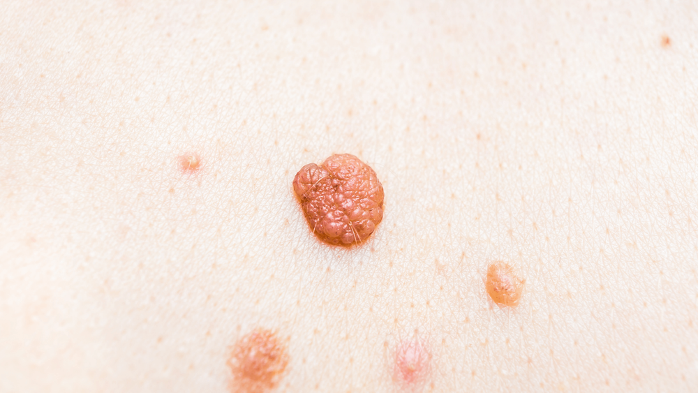Anal Skin Tags: Symptoms, Causes, Recovery