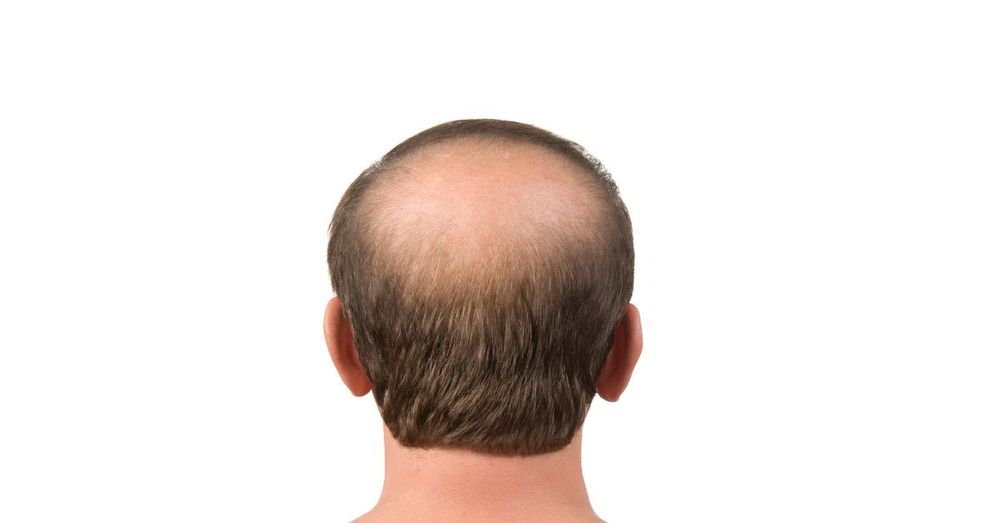 Why can pulling gray hair cause baldness? - Vietnam.vn