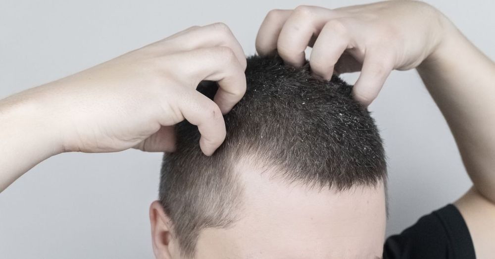 8 Natural Remedies for Hair Loss - Harley Street HTC