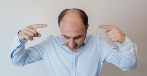 What Are Signs of Balding at 20 for Men?