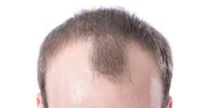 How to Stop Receding Hairline? 9 Science Backed Tips to Follow!