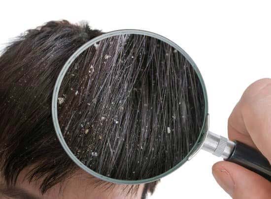 Ketoconazole for dandruff | Ketoconazole Shampoo & Oil