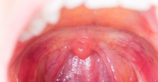 10 Instant Home Remedies for Tonsils That You Should Know!